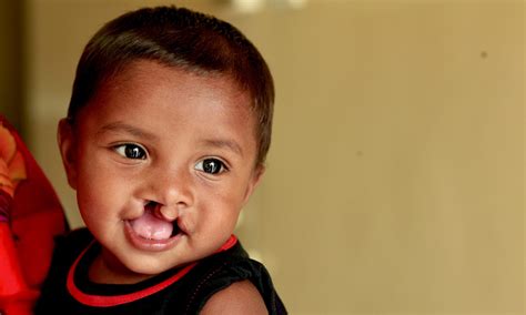 Contact Us Operation Cleft