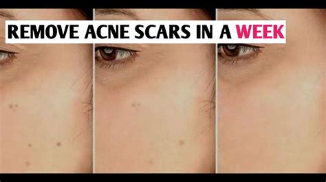 How To Get Rid Of Acne Scars Pigmentation And Age Spots Youtube
