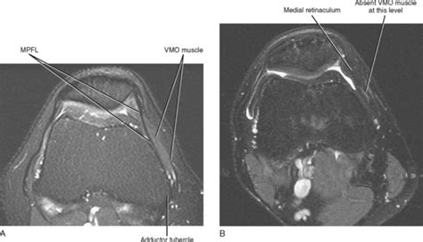 Knee Muscle Anatomy Axial Mri Use The Mouse To Scroll Or The Arrows