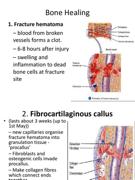 How to support the healing of bone. Stage of Fracture Healing