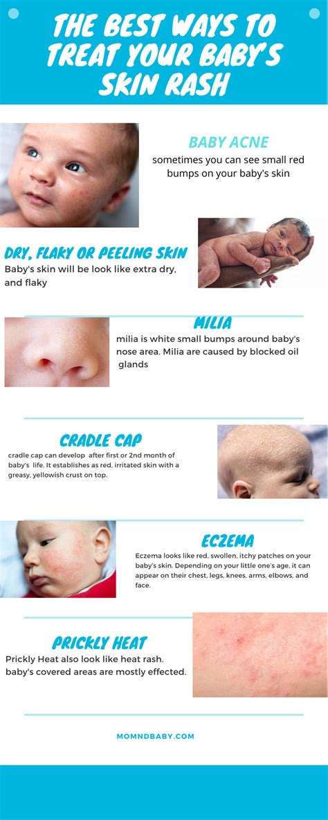 Baby Acne Or Eczema Alexandrakesteven