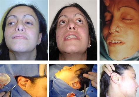Auxiliary Procedures In The Nasal Skin Intechopen