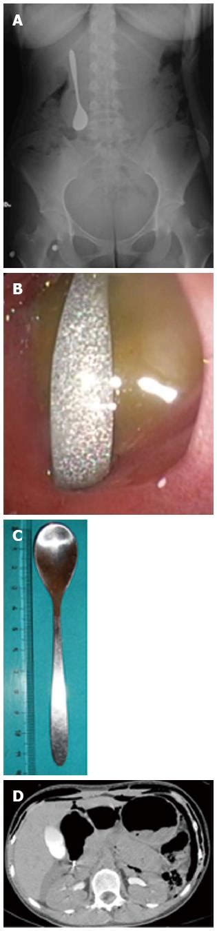 Endoscopic Retrieval Of A Duodenal Perforating Teaspoon