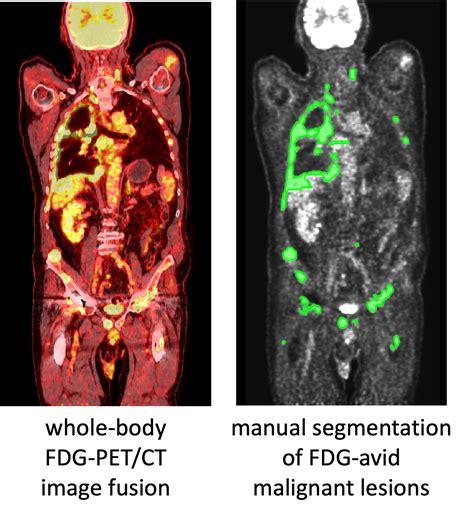 A Whole Body Fdg Petct Dataset With Manually Annotated Tumor Lesions