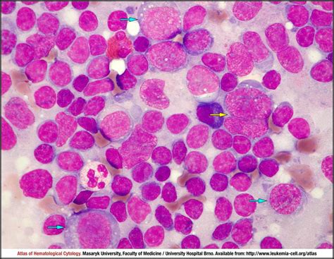 Angioimmunoblastic T Cell Lymphoma Cell Atlas Of Haematological