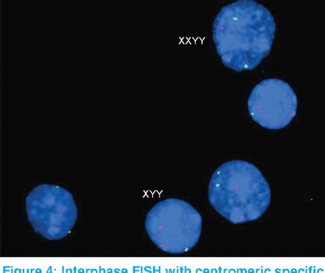 Figure 1 From A New 48 Xxyy47 Xyy Syndrome Associated With Multiple Skeletal Abnormalities
