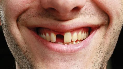 Miracle Tooth Regrowing Drug To Begin Human Trials Next Year Daily