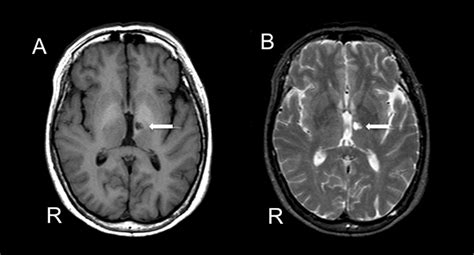 Cerebral Single Photon Emission Computer Tomography In Thalamic Lacunar