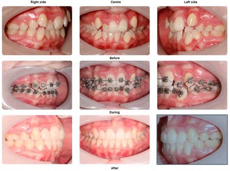 Braces Before And After Photo Gallery Orthodontics