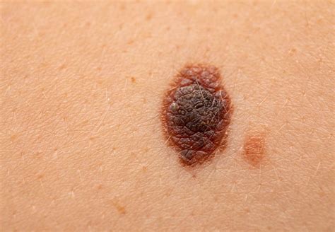 How To Spot Cancerous Moles Cleveland Clinic