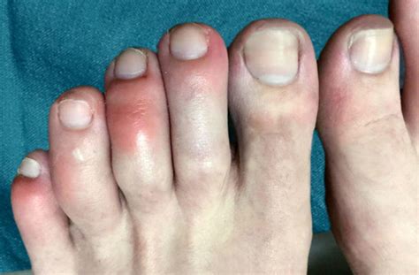 A Bit Like Frostbite Covid Toes Becoming More Common Cbs Colorado