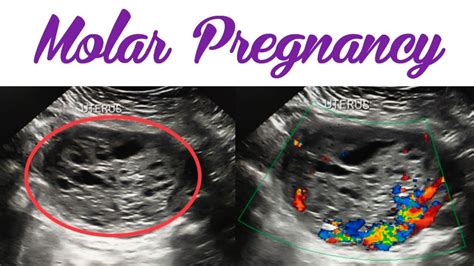 Molar Pregnancy On Ultrasound Gestation Trophoblastic Disease