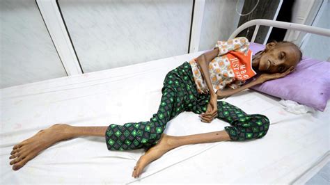 Photos Emaciated Teen The Face Of Famine In Yemen Inches To Recovery Hindustan Times