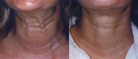 Botox® Cosmetic Before And After Photos By Dr Flor A Mayoral Md