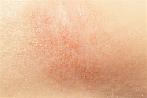 The skin is the body's biggest organ, and as such, there are a lot of ways it can go wrong. Types of skin diseases | About Health Problems
