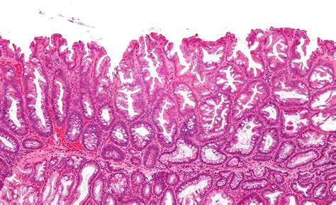 Filesessile Serrated Adenoma 3 Intermed Mag Wikimedia Commons