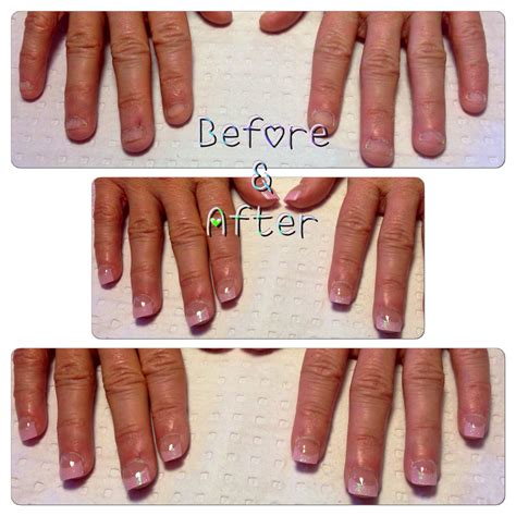 Before And After Shot Of A Nail Biter Acrylic Tips Nails Black Acrylics