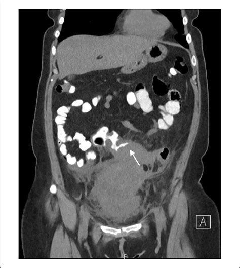The Ct Of The Abdomen And Pelvis With Oral And Rectal Contrast Coronal
