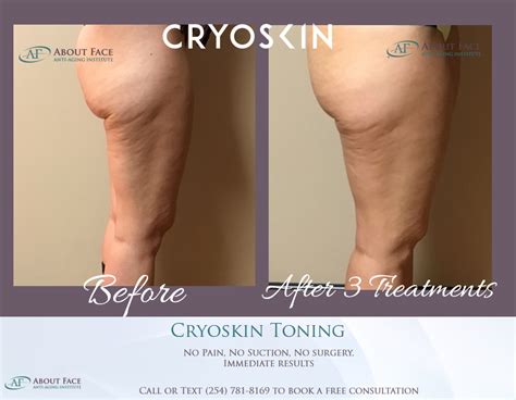 Cryoskin Before And After Pictures ColinJaydyn