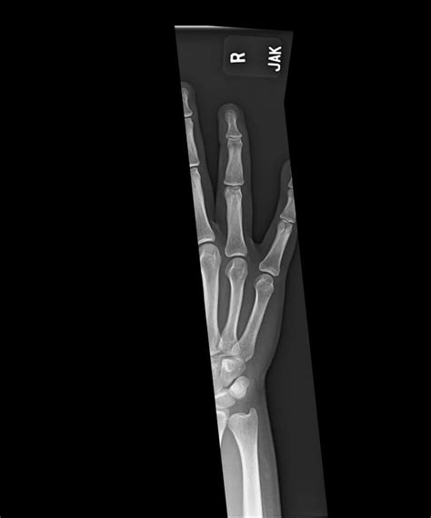 Orthodx Pain In Dip Joint Of Ring Finger Clinical Advisor