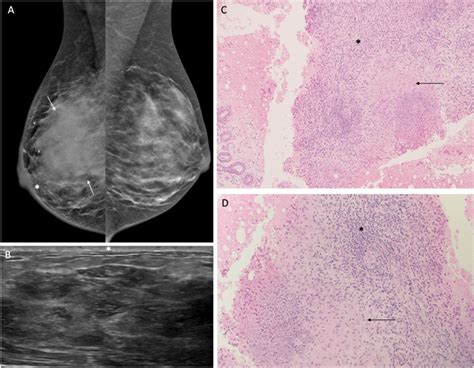 Idiopathic Granulomatous Mastitis In A 46 Year Old Woman With 10 Month