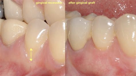 Gingival Graft For Treatment Of Gum Recession Gingival Graft For