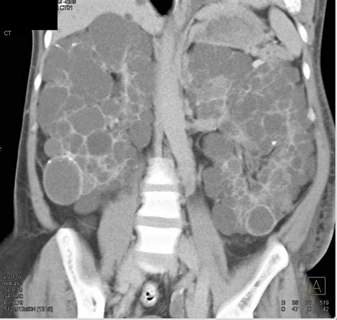 Polycystic Kidney Disease With Polycystic Liver Disease Kidney Case