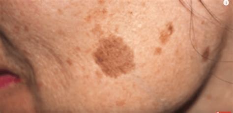 Simple Trick To Remove Brown Spots From Your Skin Tiphero
