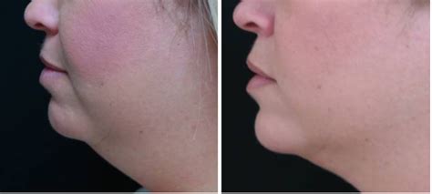Coolsculpting For Double Chin Coolsculpting For Neck Katy Houston Tx