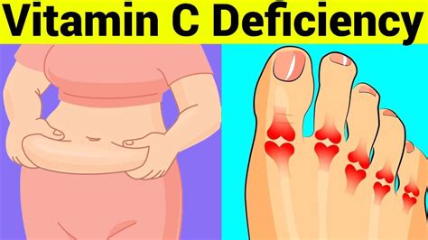 Signs And Symptoms Of Vitamin C Deficiency Youtube