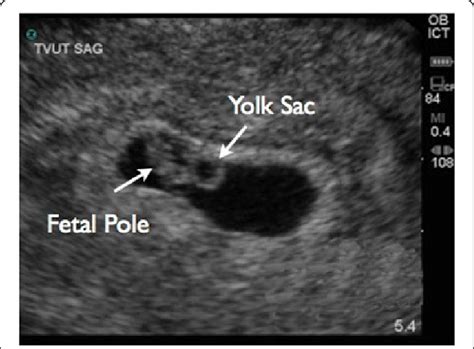 Trans Vaginal Ultrasound Image Showing Yolk Sac And Fetal Pole Sexiezpix Web Porn