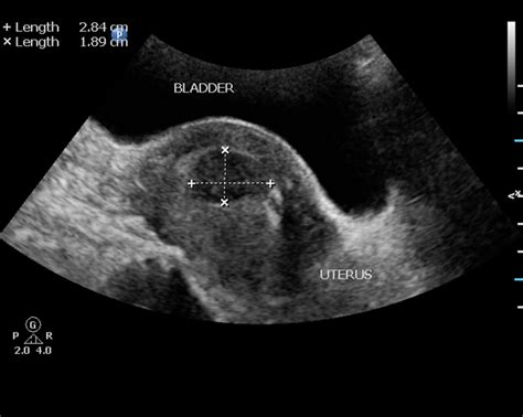Uterine fibroids are noncancerous tumors in the uterus. Fibroid Cyst On Ovary | Fibroids, Medical ultrasound ...