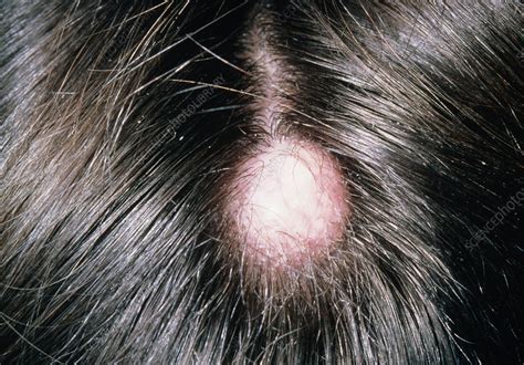 Sebaceous Cyst On Mans Scalp Stock Image M1300143 Science Photo