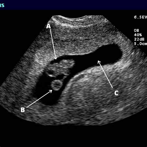 pregnancy essentials part 2 your first ultrasound and sonogram daniel niku md ms