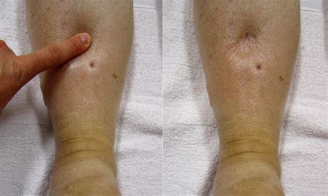 Pitting Edema Symptoms Causes And When To See A Doctor