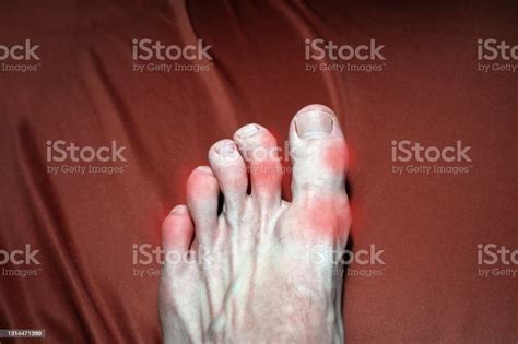 Inflamed And Deformed Joints On The Toes Due To Arthritis Or Gout