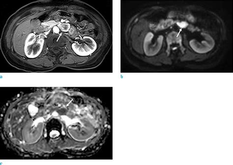 Mri Findings Of An Ampulla Of Vater Neuroendocrine Tumor With Liver And