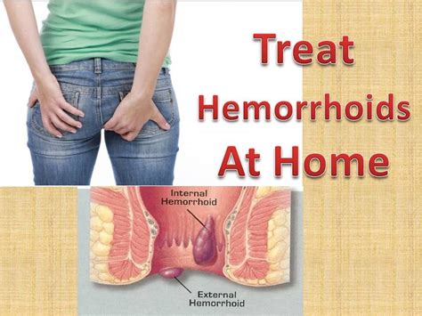 how to treat hemorrhoids at home quickly and naturally without surgery youtube