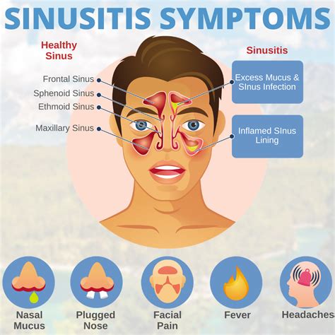 Sinusitis Symptoms Artofit
