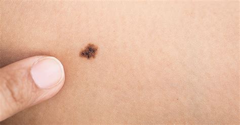 10 Signs Your Moles Are Malignant