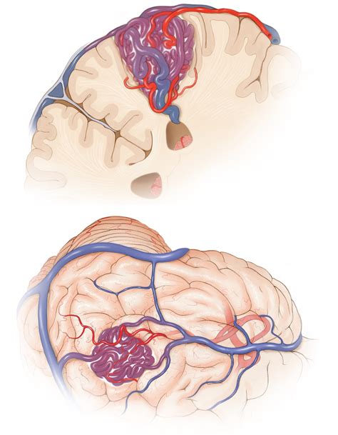 Parietal And Occipital Avms The Neurosurgical Atlas By Aaron Cohen