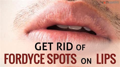 12 Ways To Get Rid Of Fordyce Spots On Lips Healthspectra Youtube
