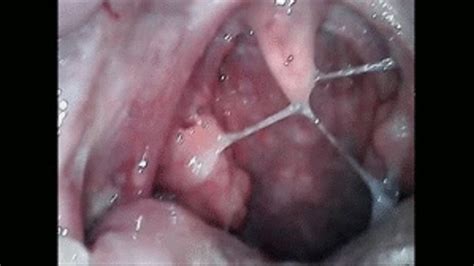 Phlegm Endoscopy Of The Throat And Nose Angiejoy Clips4sale