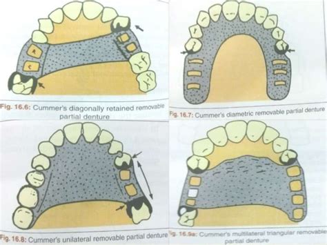 Kennedy S Classification Of Removable Partial Denture Design Talk