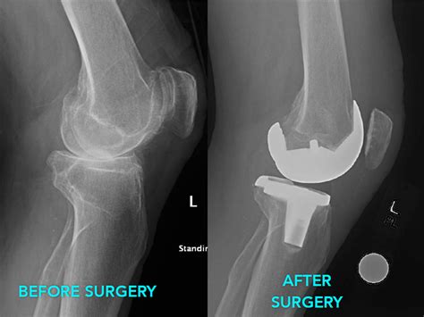 Total Knee Arthroplasty Surgical Video Plexus Surgical Video Gambaran