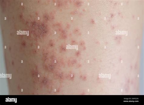 Close Up Of Skin Rashes Caused By Allergies Rashes Are Caused By Food