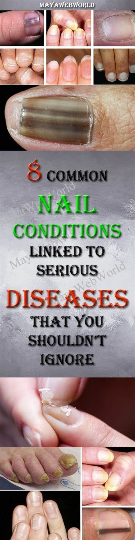 8 common nail conditions linked to serious diseases that you shouldnt ignore fitness health