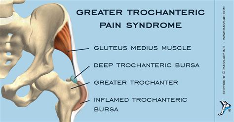 The 25 Best Greater Trochanteric Pain Syndrome Ideas
