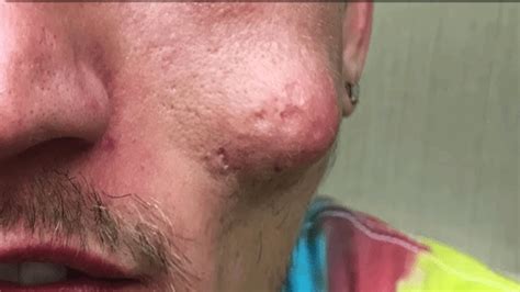 Reddits Top Pops Best Dilated Pores Nose Pimples And Blackhead