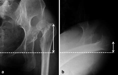Preoperative Anteroposterior Radiographs Showing The Hip In A A Neutral